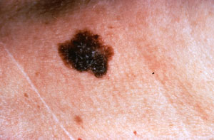melanoma skin cancer