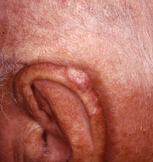squamous cell carcinoma skin cancer