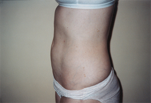 After Photo of one of Dr. Ralph Massey's Liposuction Patients