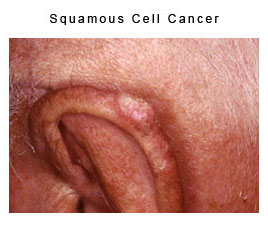 aquamous cell cancer