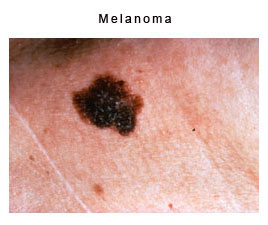 melanoma